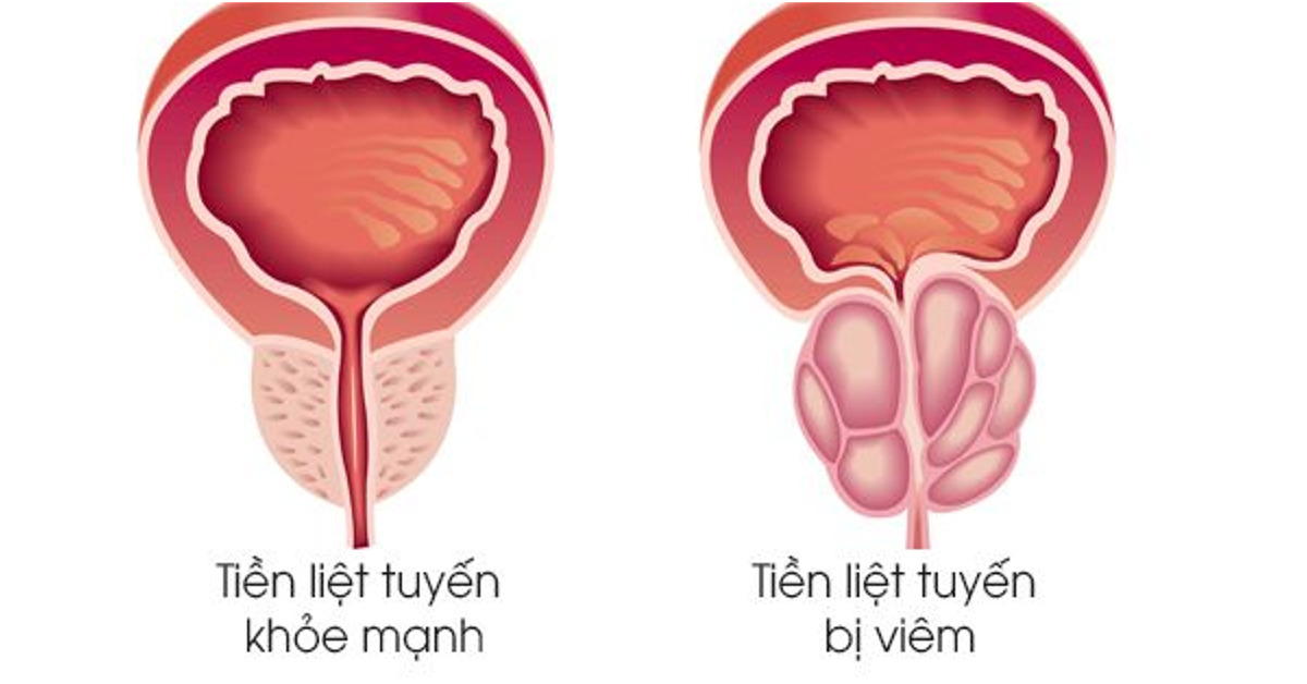 Phân loại bệnh viêm tuyến tiền liệt mãn tính