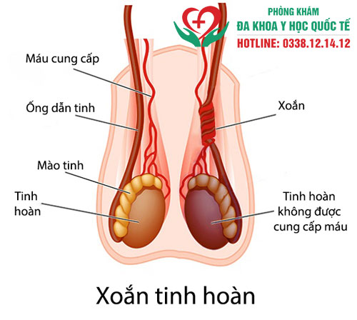 Triệu chứng xoắn tinh hoàn