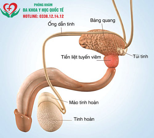 Viêm tuyến tiền liệt mãn tính là gì?