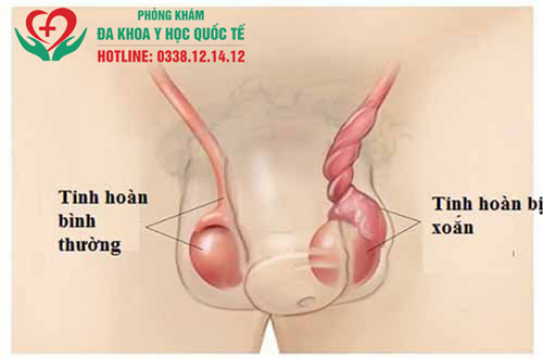 xoắn tinh hoàn có tự khỏi được không