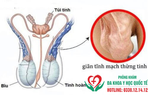 Tinh hoàn bị xệ là gì?