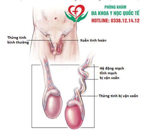 xoắn tinh hoàn nguy hiểm như nào