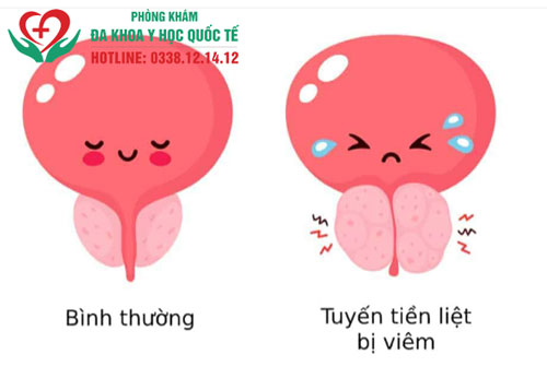 Triệu chứng viêm tuyến tiền liệt mãn tính