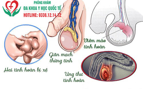 Tinh hoàn bị xệ có nguy hiểm không?