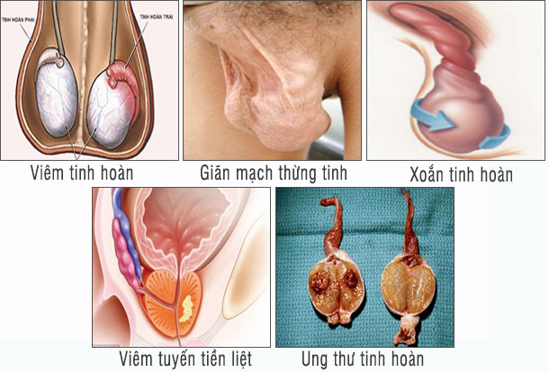 Xoắn tinh hoàn nguy hiểm như nào?