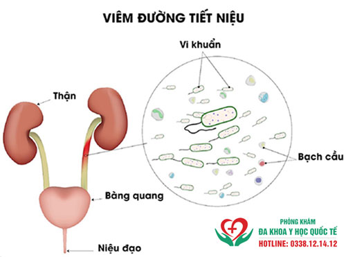 Viêm đường tiết niệu tiểu ra máu 