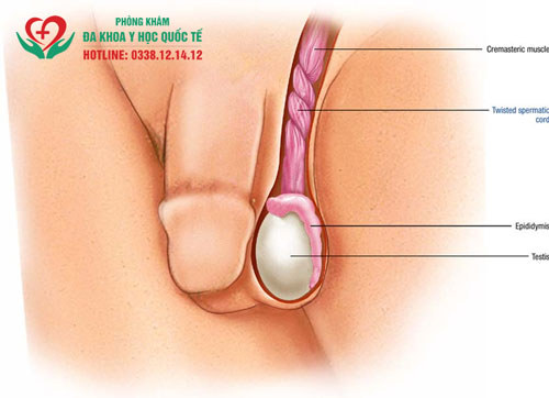 Trẻ em bị xoắn tinh hoàn