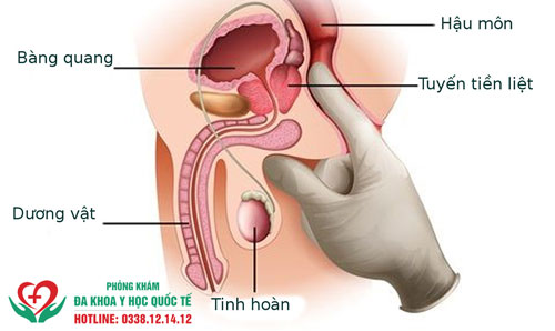 Dấu hiệu viêm tuyến tiền liệt ở nam giới là gì?