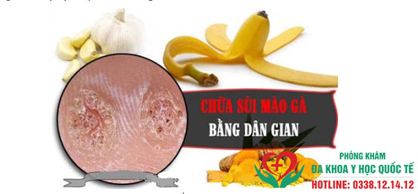 Cách chữa sùi mào gà bằng phương pháp dân gian tại nhà