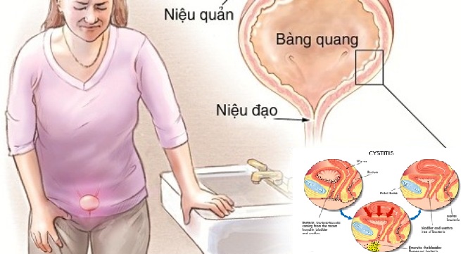 Viêm niệu đạo là gì ?