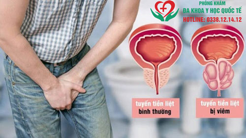 Dấu hiệu viêm tuyến tiền liệt ở nam giới là gì?