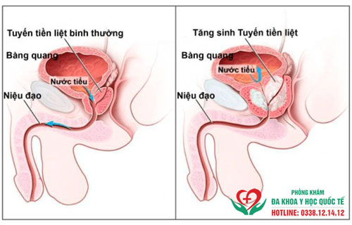 Viêm tuyến tiền liệt có quan hệ được không?