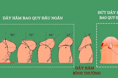 Đứt dây hãm bao quy đầu có nguy hiểm không?