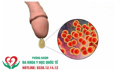 Tinh trùng khi xuất vón cục có nguy hiểm không