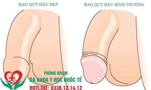 Hẹp bao quy đầu là hiện tượng như nào?