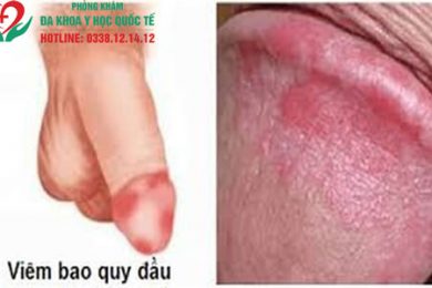 Nổi mụn thịt ở bao quy đầu do viêm bao quy đầu 