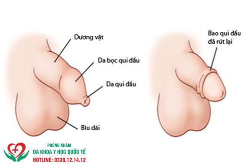 Dương vật bị sưng phù sau khi quan hệ có sao không?