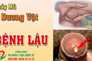 Dương vật chảy mủ trắng đục có nguy hiểm không?