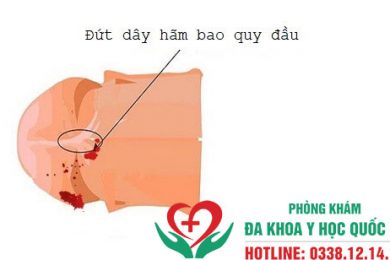 rách bao quy đầu có nguy hiểm không