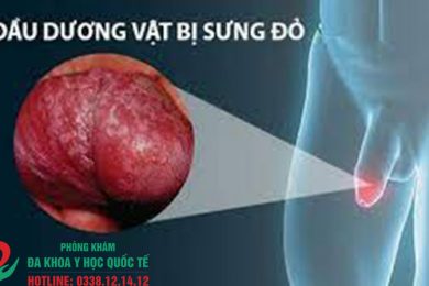 Đầu dương vật bị ửng đỏ là hiện tượng gì?