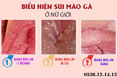 Biểu hiện giai đoạn đầu sùi mào gà ở nữ giới