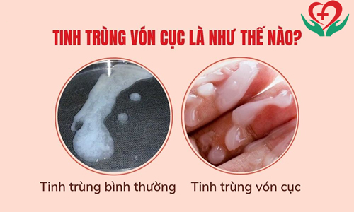 Tinh trùng vón cục có nguy hiểm không?