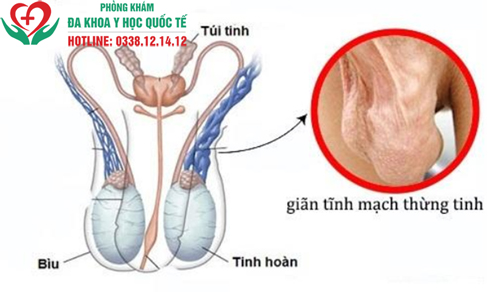 Xuất tinh ra máu là dấu hiệu của bệnh gì?