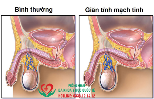 Đau nhói ở một bên tinh hoàn có nguy hiểm không?