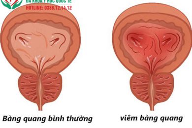  Viêm túi tinh: Nguyên nhân, triệu chứng và cách điều trị