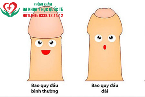 Dài bao quy đầu có nguy hiểm không?