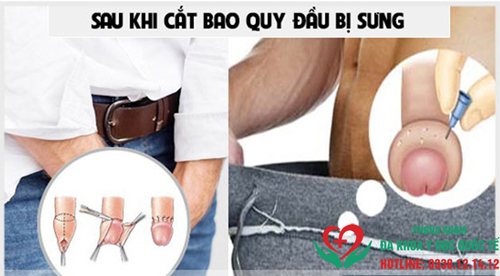 Bao quy đầu bị sưng sau khi cắt có sao không?