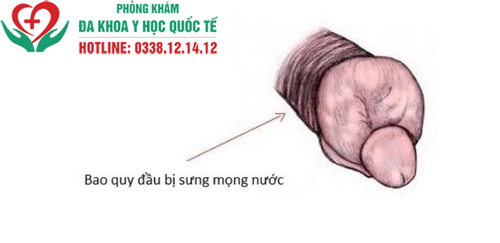 Bao quy đầu bị sưng sau khi cắt có sao không?