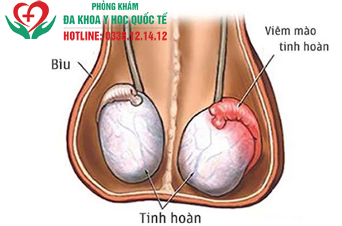 Đau nhói ở một bên tinh hoàn có nguy hiểm không?