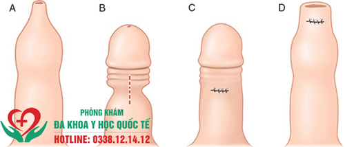 Dài bao quy đầu có nguy hiểm không?