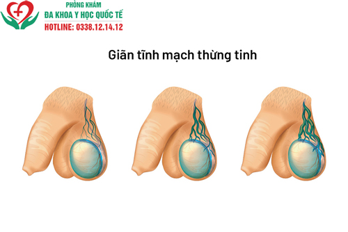 Đau tức tinh hoàn kéo dài có sao không?