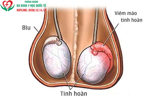 Viêm mào tinh hoàn nó tự khỏi được không?