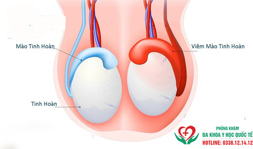 Viêm mào tinh hoàn nó tự khỏi được không?