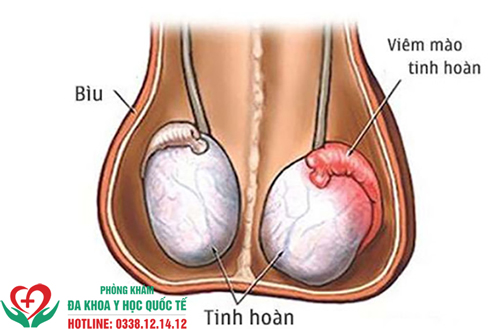 Viêm mào tinh hoàn có nguy hiểm không?