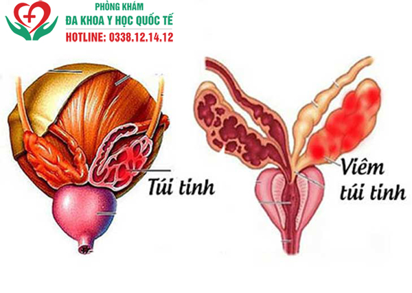  Viêm túi tinh: Nguyên nhân, triệu chứng và cách điều trị