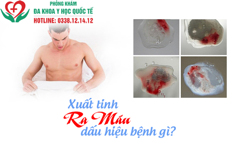 Xuất tinh ra máu là dấu hiệu của bệnh gì?