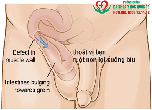 Viêm mào tinh hoàn ở trẻ em có nguy hiểm không?