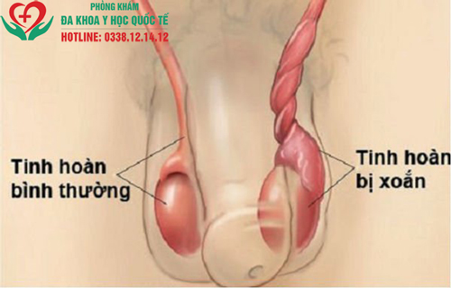 Viêm mào tinh hoàn ở trẻ em có nguy hiểm không?