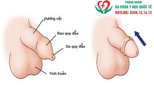 Viêm mào tinh hoàn ở trẻ em có nguy hiểm không?