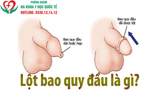 Tự lột bao quy đầu tại nhà không đau và an toàn