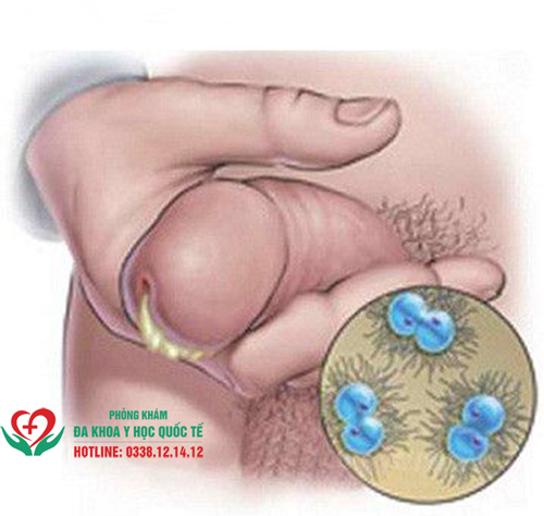 Dương vật ra dịch nhờn bất thường là như thế nào?