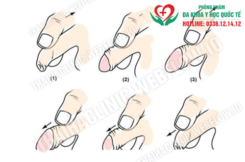 Cách tự lột bao quy đầu không đau tại nhà