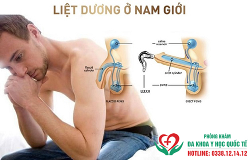 Bệnh liệt dương ở nam giới 