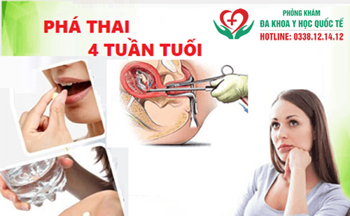 Đình chỉ thai 4 tuần có được không?