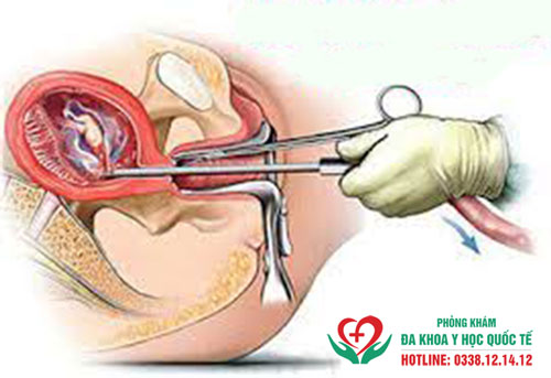 Đình chỉ thai 5 tuần có được không?