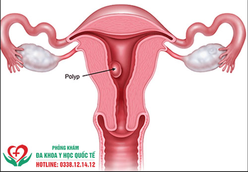 Sờ thấy mụn li ti ở cổ tử cung là dấu hiệu cảnh báo bệnh gì?